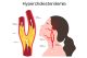 Hypercholesterolemia: How to Identify Risks and Successfully Manage It?