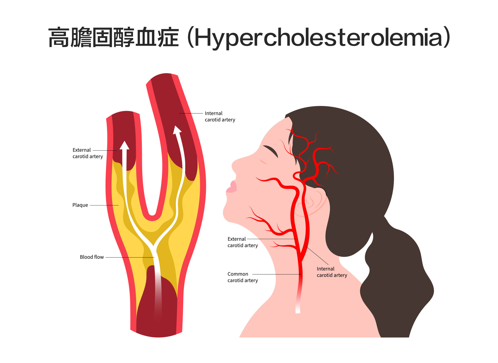 高膽固醇血症（Hypercholesterolemia）
